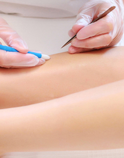 Needle epilation